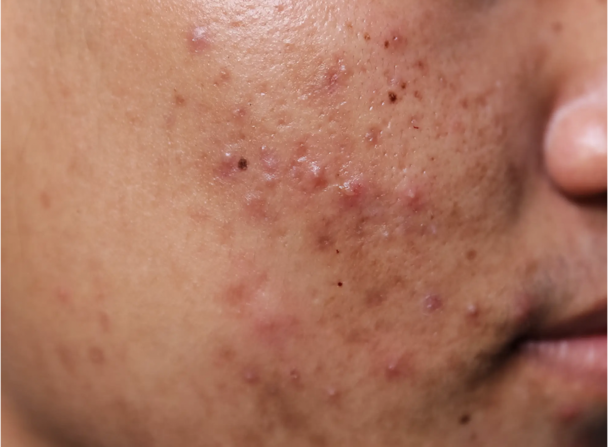 Blocked Pores And Blackheads Ascend Skin Clinics